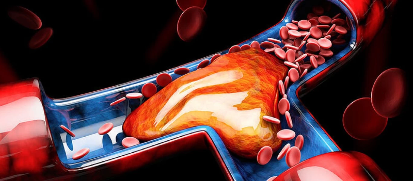 Οι θρομβώσεις είναι πιο πιθανές στους ψηλότερους ανθρώπους σύμφωνα με έρευνα